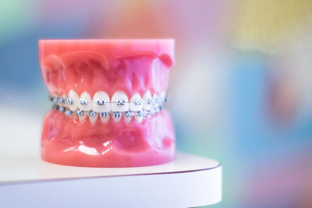 What Are the Main Elements of Braces?