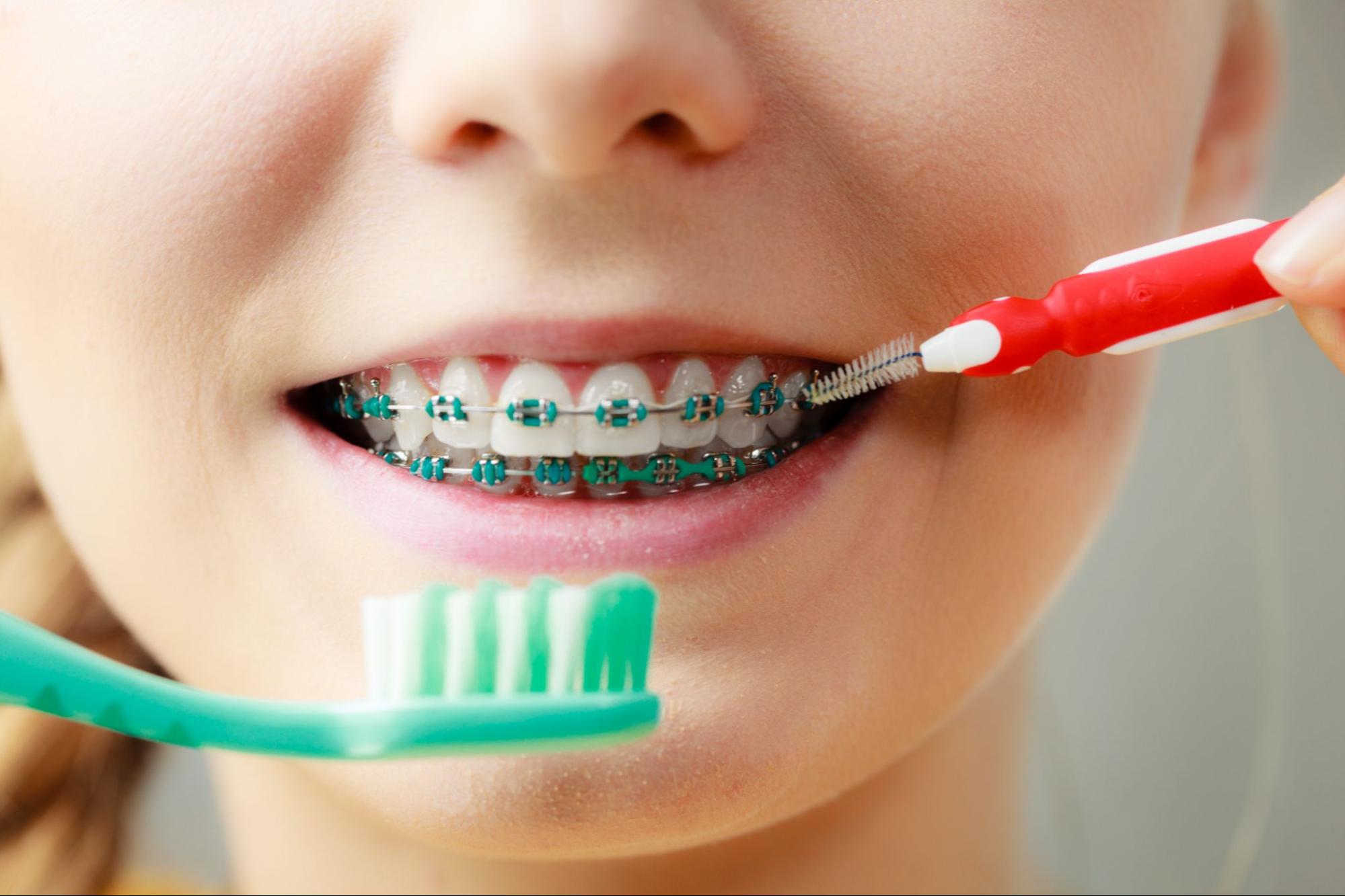 How To Care for Your Braces In Between Appointments